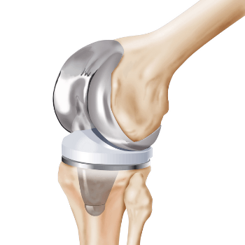 Eklem Artroplastisi